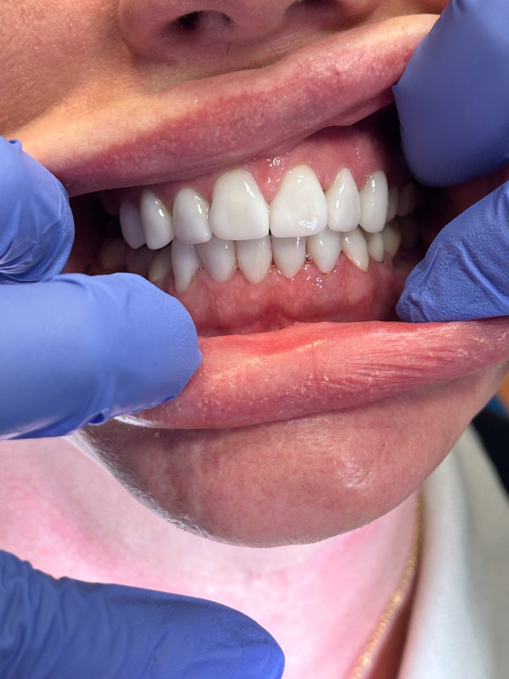 Close-up view of a smile showing upper and lower teeth